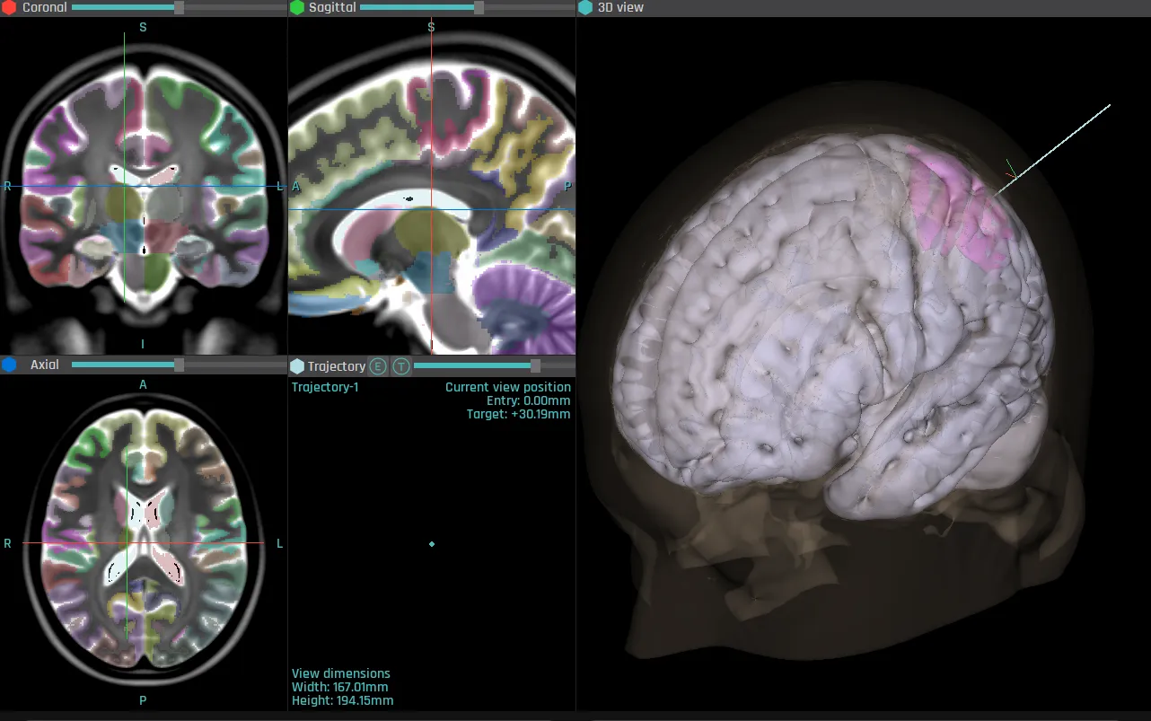 CORTEXPLORER SCI planning module with a brain atlas overlaid on coronal, sagittal and axial views and a registered 3D brain model.