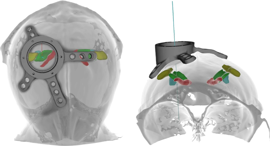 A transparent skull with a recording chamber and color-coded subcortical target structures, planned in CORTEXPLORER SCI.
